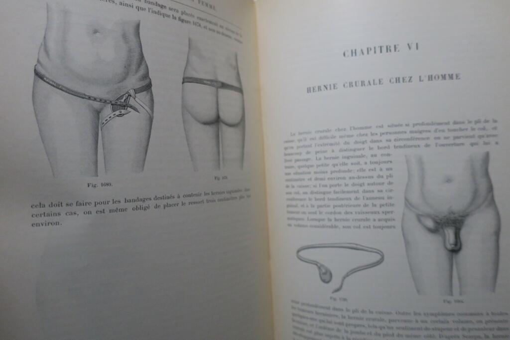 Hernia Bandages: Past and Present