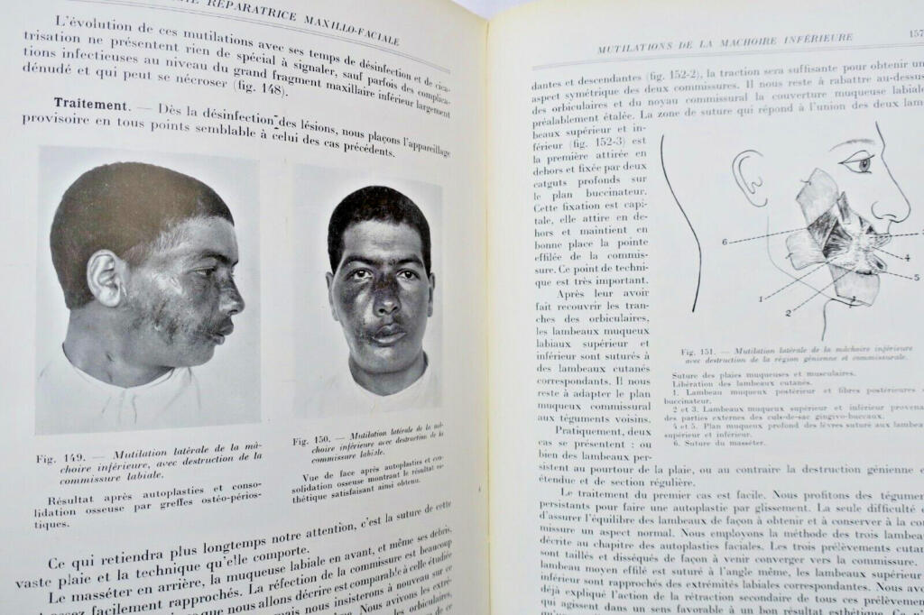Chirurgie réparatrice maxillo-faciale. Autoplasties – Prothèse – 1940
