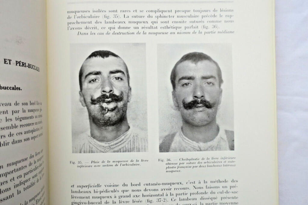 Chirurgie réparatrice maxillo-faciale. Autoplasties – Prothèse – 1940