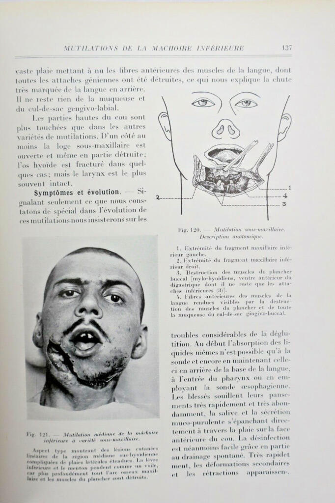 Chirurgie réparatrice maxillo-faciale. Autoplasties – Prothèse – 1940