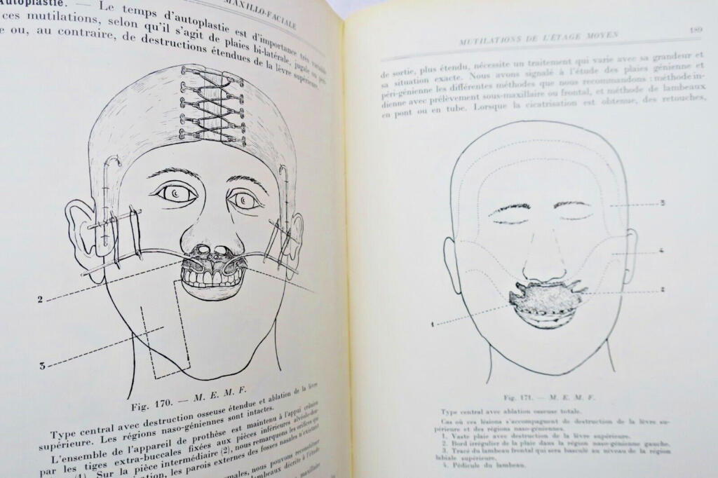 Chirurgie réparatrice maxillo-faciale. Autoplasties – Prothèse – 1940