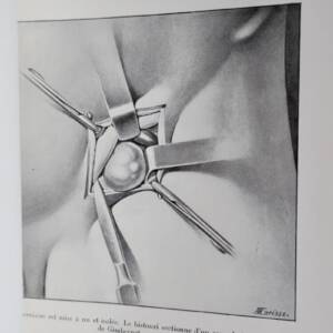 Contribution à l’étude de la cure radicale de la hernie crurale