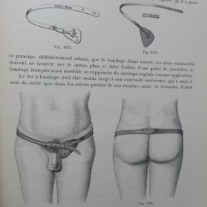 Bandage Herniaire. Früher Heute 1899