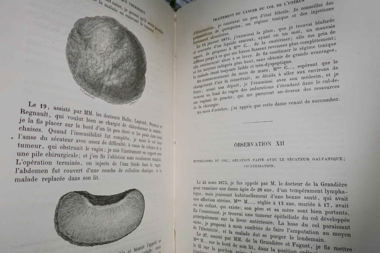 热电灼烧外科论著<span class="lla-card-orig-wrap"><span class="lla-card-orig">❦ chirurgie MEMOIRES SUR LA GALVANOCAUSTIQUE THERMIQUE 1876</span></span> - La Librairie Antique