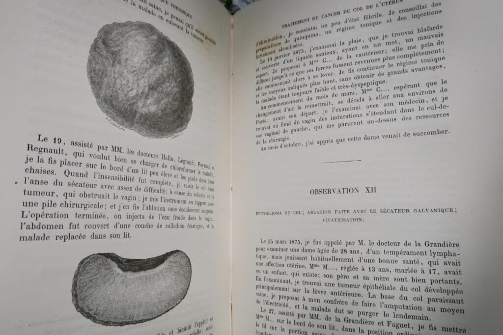 Surgical Memoirs on Thermal Galvanocausty