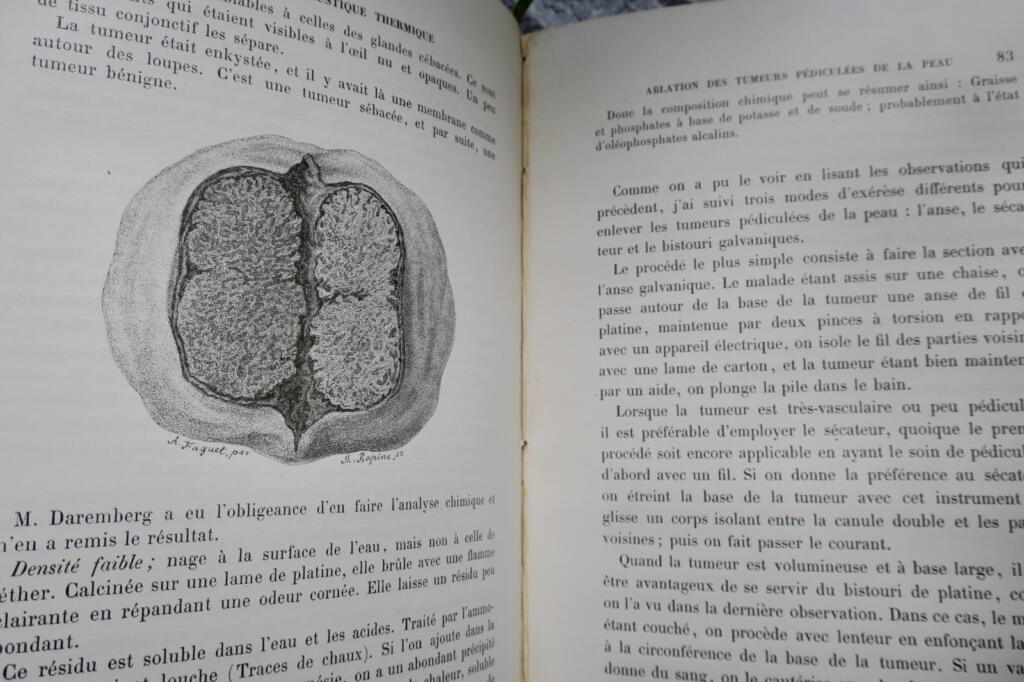 Surgical Memoirs on Thermal Galvanocausty