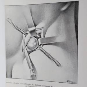 Contribution à l’étude de la cure radicale de la hernie crurale
