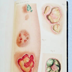 Curiosita Traité des maladies vénériennes 1859
