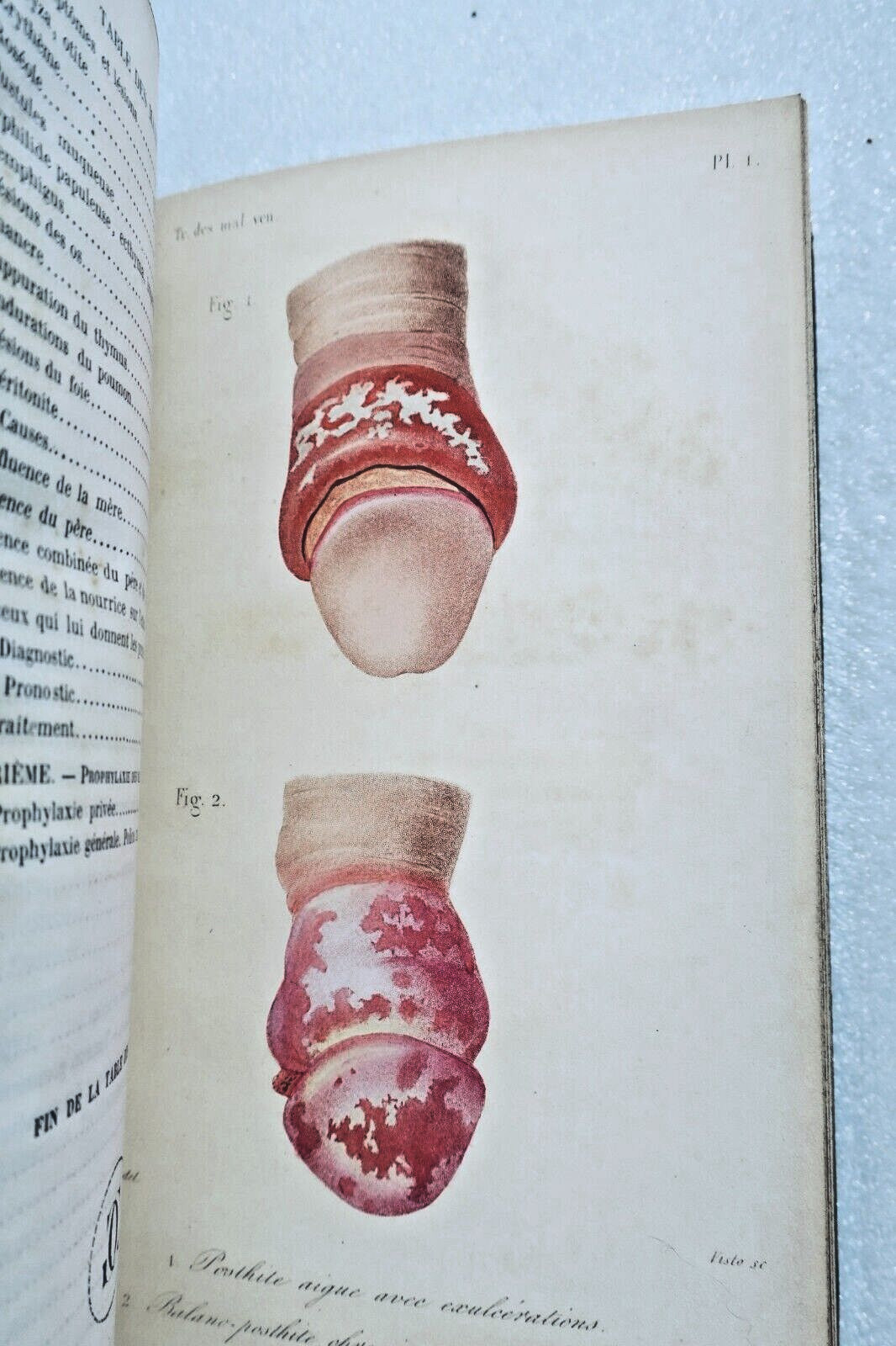 Study of Venereal Diseases<span class="lla-card-orig-wrap"><span class="lla-card-orig">❦ Curiosita Traité des maladies vénériennes 1859</span></span> - La Librairie Antique