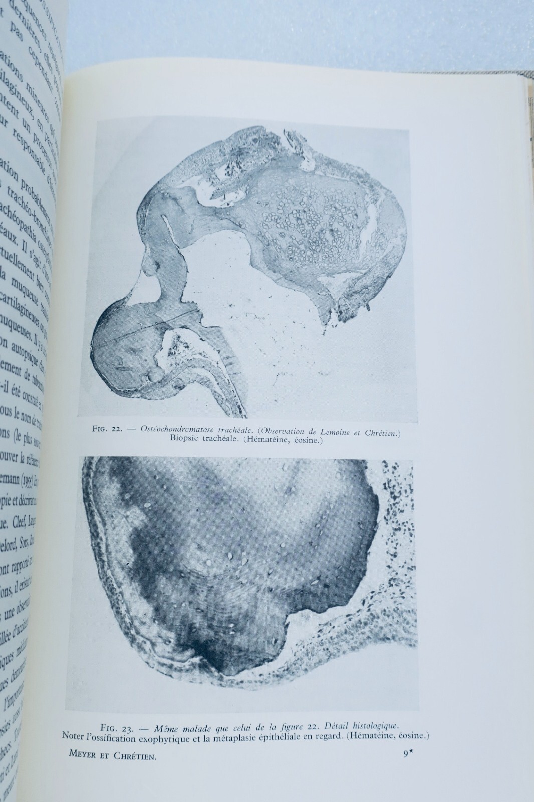 Einblicke in tracheobronchiale Blutungen - Image 3