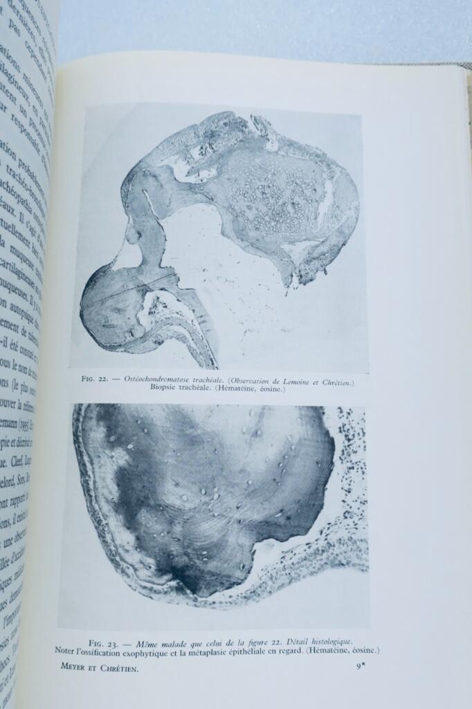 Tracheo-bronchial hemoptysis