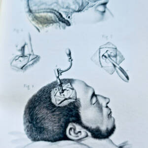 anatomie Bernard & Huette Précis iconographique de médecine opératoire 1846