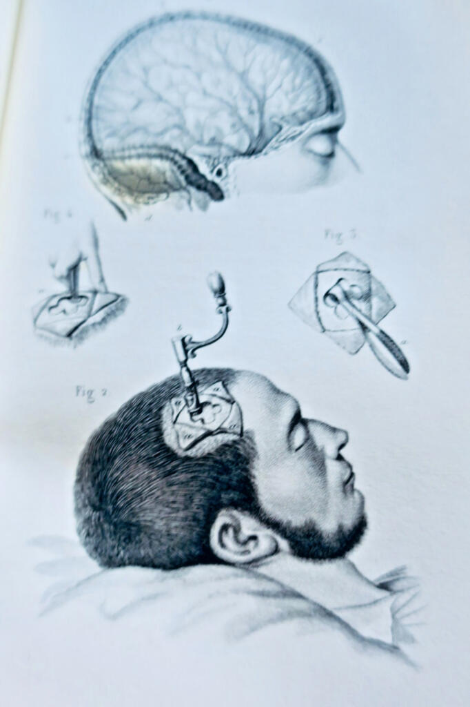 anatomie Bernard & Huette Précis iconographique de médecine opératoire 1846