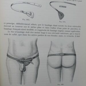 Bandage Herniaire. Autrefois Aujourd'hui 1899