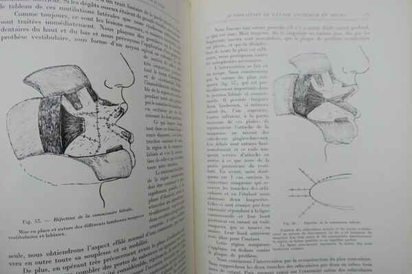 Chirurgie réparatrice maxillo-faciale. Autoplasties - Prothèse - 1940 – Image 8