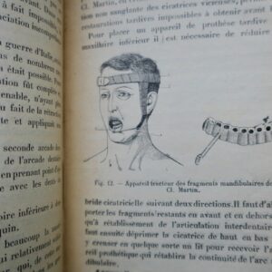 Prothèse restauratrice bucco-faciale et traitement des fractures..1915